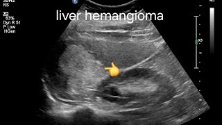 Large hemangioma of liver, ultrasound imaging, management and prognosis