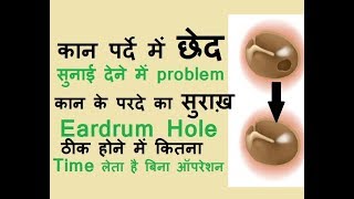 कान के परदे में छेद (hole) होने से कितना कम सुनाई देता है? सुराख़ ठीक,बंद होने में कितना समय लेता है