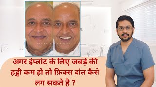 ZYGOMATIC implants ||  जबड़े की हड्डी कम होने पर इम्प्लांट कैसे होग।| Dr Ankit Khasgiwala