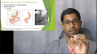 Revision Series, Gastric Sleeve 2