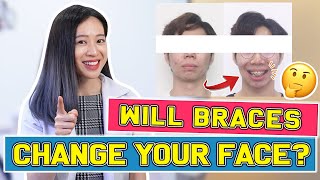 Will Braces Change Your FACE? | #BraceYourself!🦷