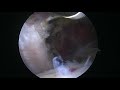 arthroscopy assisted latissimus dorsi transfer for irreparable subscapularis tears