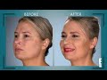 holly’s razor thin nose full transformation botched e