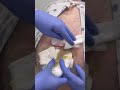 Massive Abscess Removal on Back