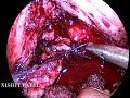 laparoscopic vasicovaginal fistula