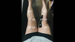 MPFL Reconstruction Recovery 5 Months op