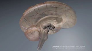 Animation - Stentrode and brain catheter