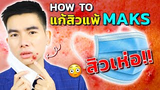 4 วิธีรักษา สิวแพ้แมส สิวแพ้หน้ากากอนามัย สิวเห่อ !! (Maskne)