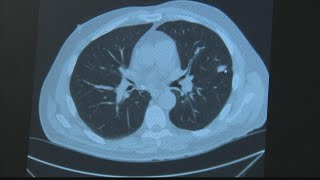 Check Up 13: Lung cancer screening
