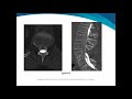 myelography in the orthopedic hospital