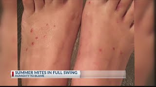 Chigger bite infestation in East Texas