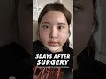 plastic surgery in korea cheekbone mandible jaw