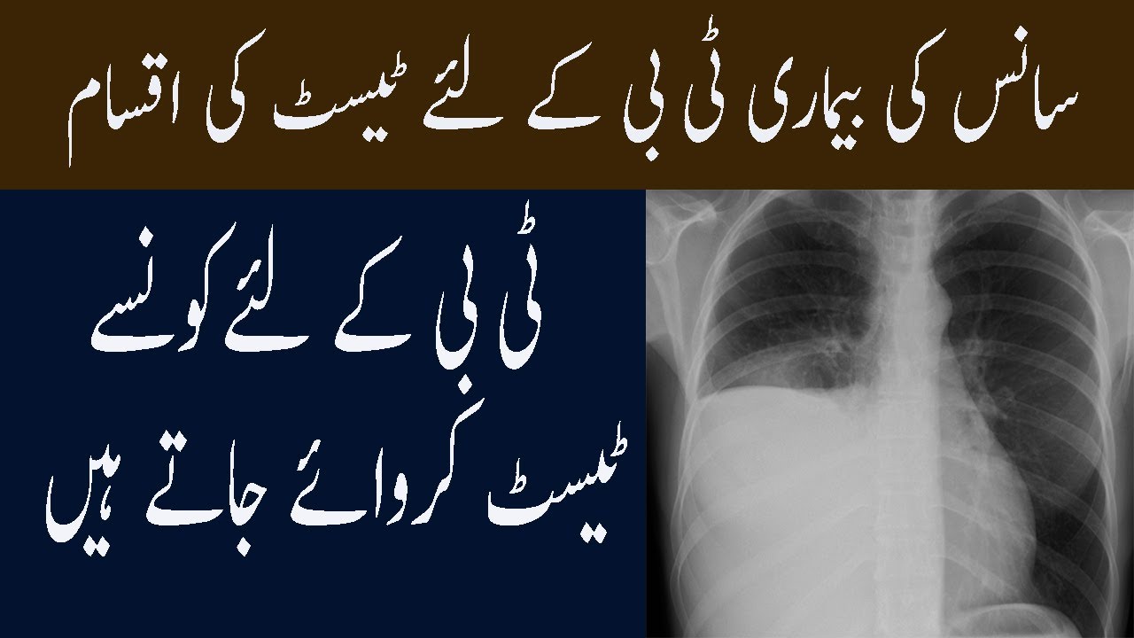 Type Of Test And Diagnosis For Tuberculosis In Urdu Tap E Diq Tb Ke Lye ...