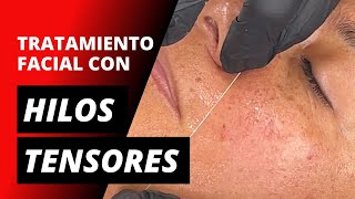 Tratamiento facial con hilos tensores re-absorbibles