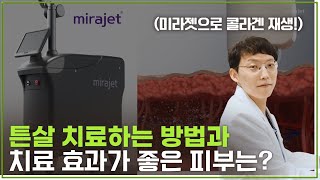 튼살 치료 시술 방법\u0026과정과 치료가 잘 되는 피부는? (레이저 치료 미라젯)