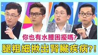 你也有水腫困擾嗎？腿的粗細竟能揪出腎臟疾病？！【醫師好辣】 必看精彩片段 陳保仁 江坤俊 田知學