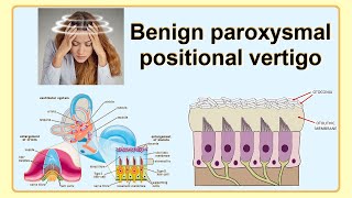 benign paroxysmal positional vertigo