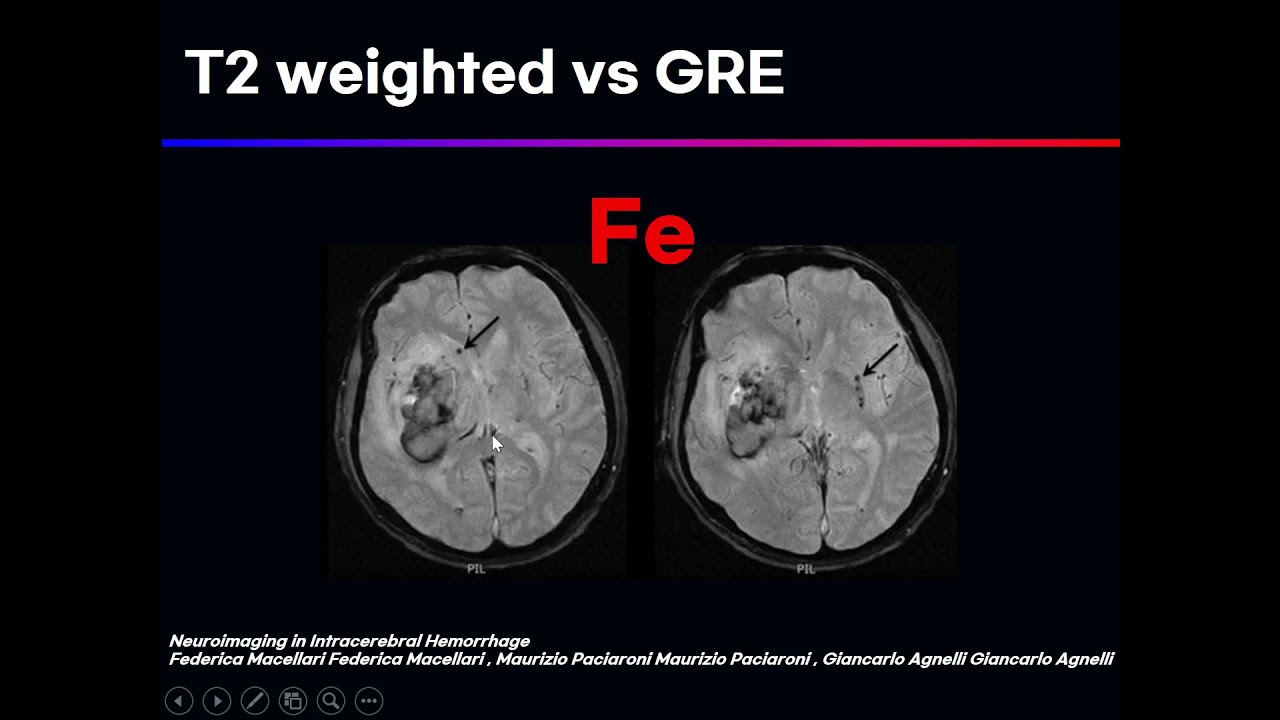 T2 Weighted Image(clinical) - YouTube