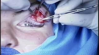 Excision of superior lateral dermoid cyst