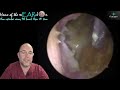 fungal mastoid cavity 237 ear earwax earwaxremoval earcleaning fungal asmr fyp mastoid