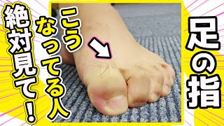 【ハンマートゥ】なぜ指がかかんでしまう？適切なケア方法まで！