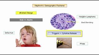 12DaysinMarch, Glomerulopathies, Part 2. Nephrotic Disorders for the USMLE Step One Exam