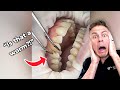 Worms Living In Your Gums?! Orthodontist Reacts!