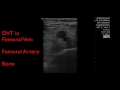 ultrasound in pathology dvt