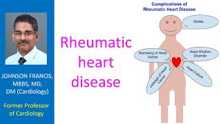 Rheumatic heart disease