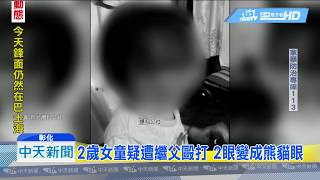 20190530中天新聞　2歲女童疑遭繼父毆打　2眼變成熊貓眼