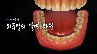 [명의 의학백과📖] 치주염의 발병 과정