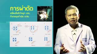 ภาวะหัวใจเต้นผิดจังหวะชนิด Atrial Fibrillation (AF)