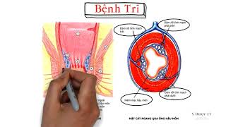 Bệnh trĩ là gì | Bệnh Học | Y Dược TV