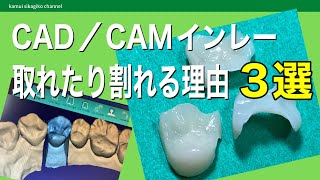 【歯科技工士】保険適用のハイブリッドセラミックCAD／CAMインレーが取れたり割れる理由3選【exocad3.0】