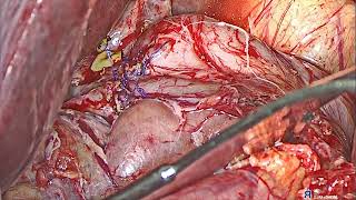 Digital Choledochoscopy Techniques for Stone Extraction from the Biliary Tree