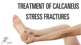 How do you treat a calcaneus stress fracture?