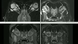 Neuroimaging Takeover - Week 4 (Neuroimaging Findings)