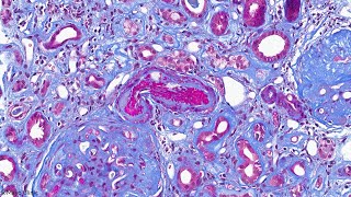 Complement Testing in the Diagnosis and Management of Thrombotic Microangiopathy