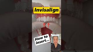 How to Properly Insert and Fit Your Invisalign Aligners #dentallan #dentist #shorts