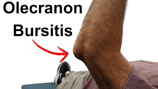 Olecranon Bursitis