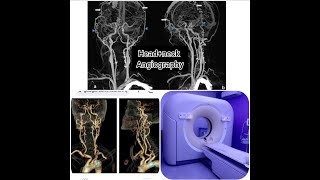 CT Head+ neck Angiography with bolus track