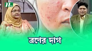 মুখে ব্রণের কালো দাগ থেকে মুক্তির উপায় । Health Show | স্বাস্থ্য প্রতিদিন |