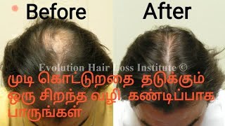 எப்படி இழந்த  உங்கள் முடியை வளர வைப்பது/ How to Regrow of your hair