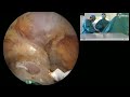 arthroscopic latarjet with screws technique tips and tricks