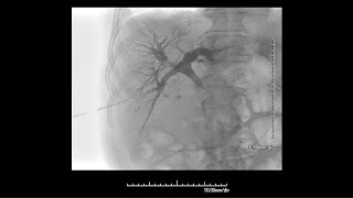 GORE® VIABIL® Biliary Endoprosthesis - Percutaneous placement video