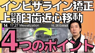 インビザライン矯正治療で上顎大臼歯の近心移動する時に気をつける4つのポイント