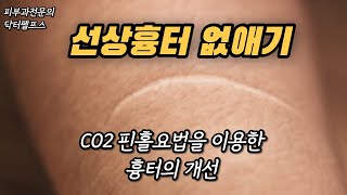 선상의 수술흉터는 과연 없앨 수 있을까요? 피부과전문의와 함께 알아보겠습니다.