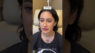 Before, After! Trifecta Lift with Dr. Kami Parsa | 3 Months Post-Op