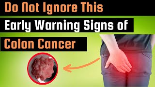 Early Warning Signs Of Colon Cancer | Colon Cancer Symptoms & Causes