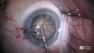 Mature Cataract Removal with miLOOP